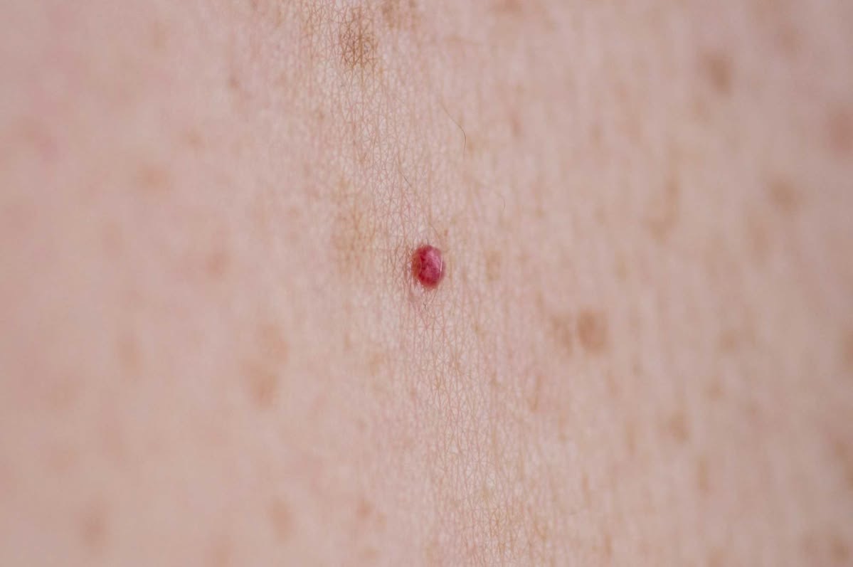 Cherry angioma laser treatment aberdeen