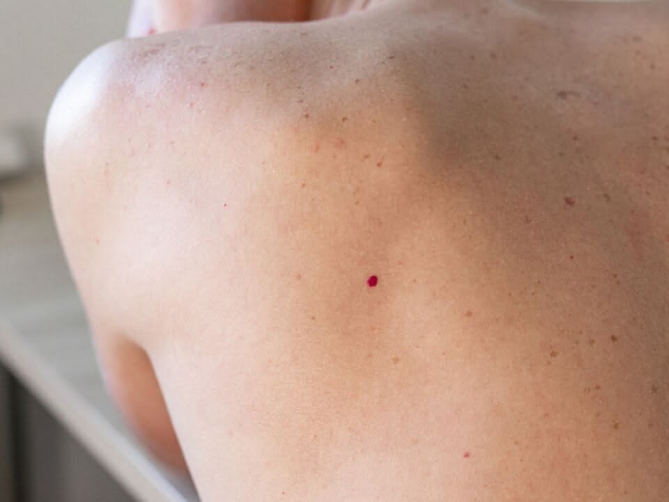 Cherry angioma laser treatment