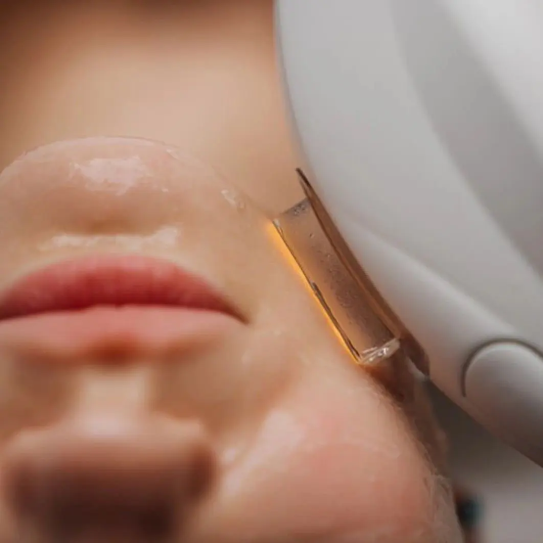 Photorejuvenation Aberdeen