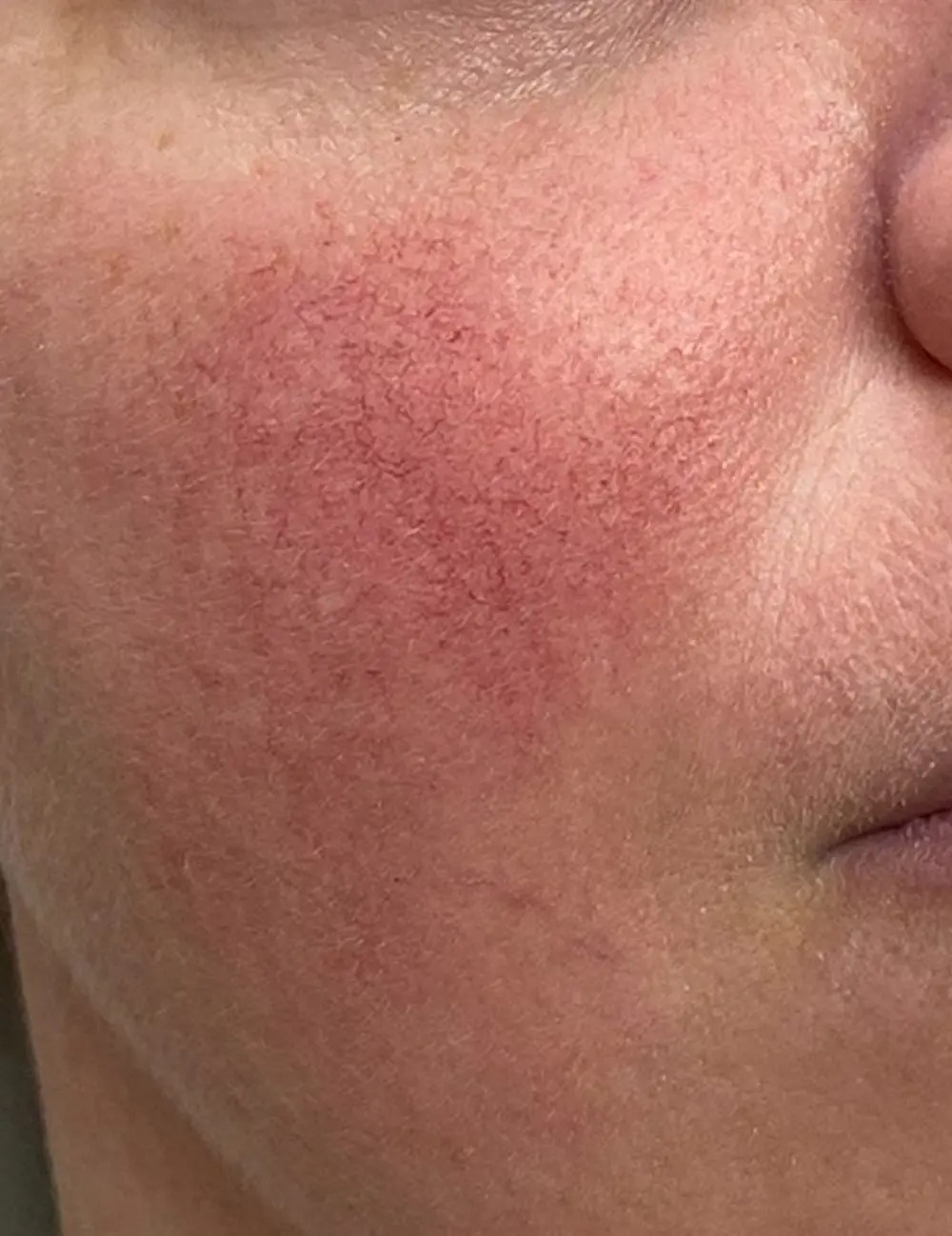 Redness Rosacea Therapy Aberdeen