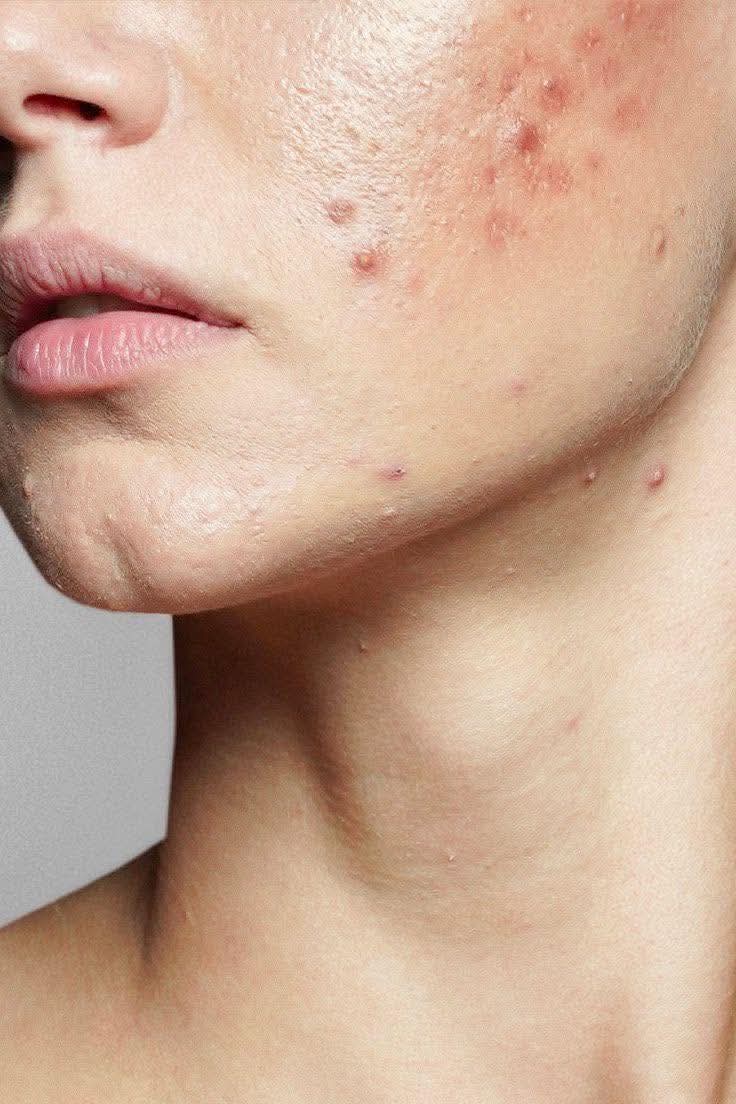 Skin clarifying treatment for acne-prone skin aberdeen