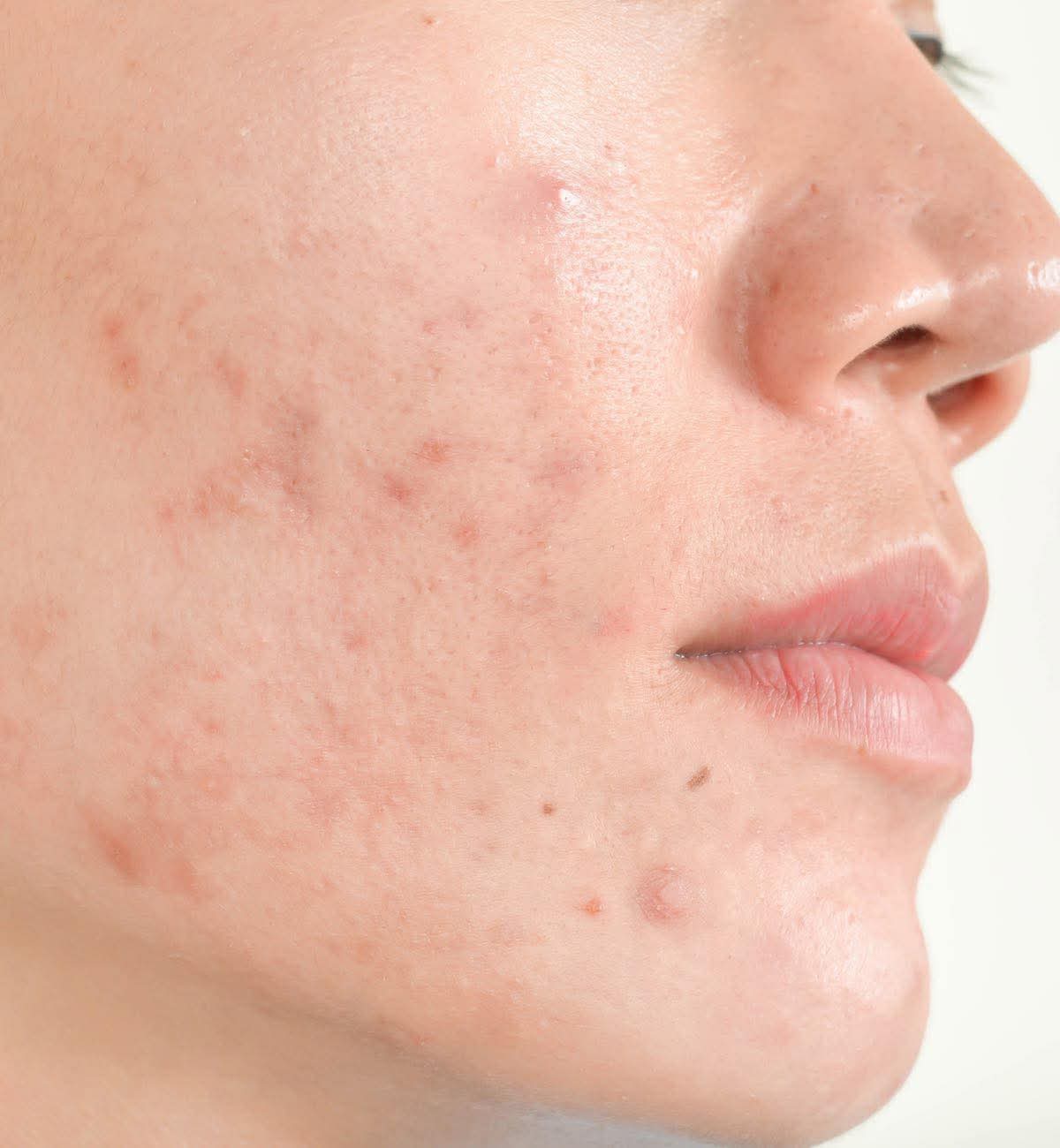 Skin clarifying treatment for acne-prone skin clinic aberdeen