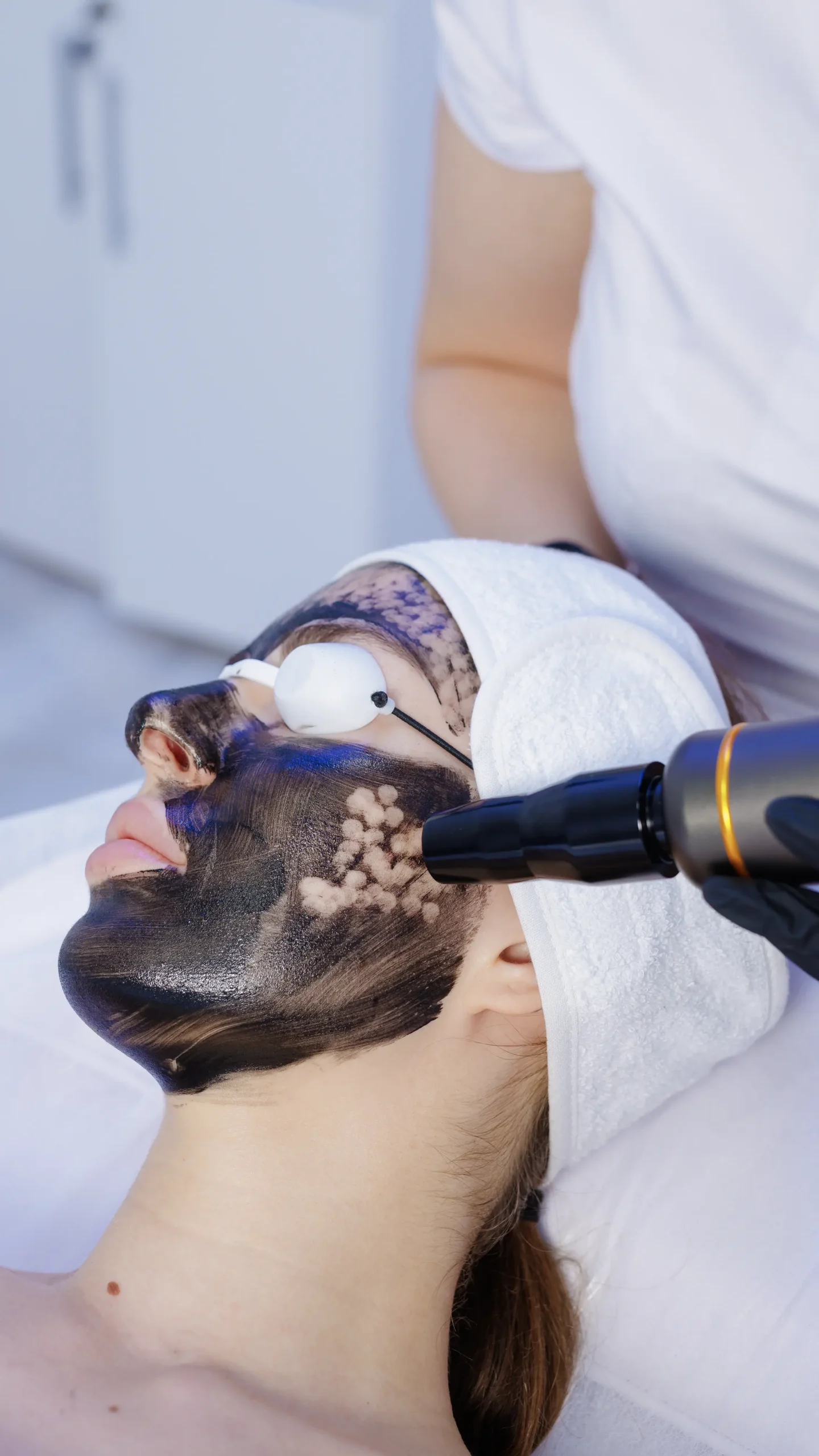 carbon laser peel
